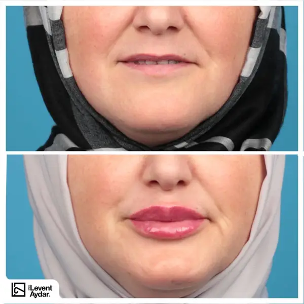 Lip Fillers