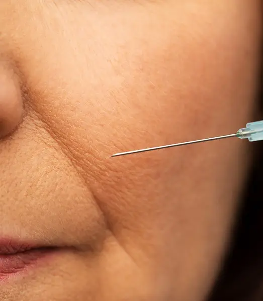 Cheek Line Filler