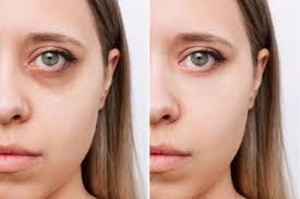 Under Eye Light Filling