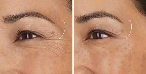 Eye Contour Botox